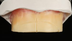 Maxillary Bite Block