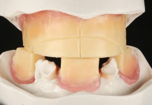 Mandibular and Maxillary Bite Blocks Wax Rims Bite Registration